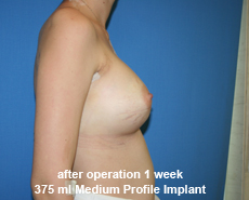 plastic-surgery-breast-augmentation